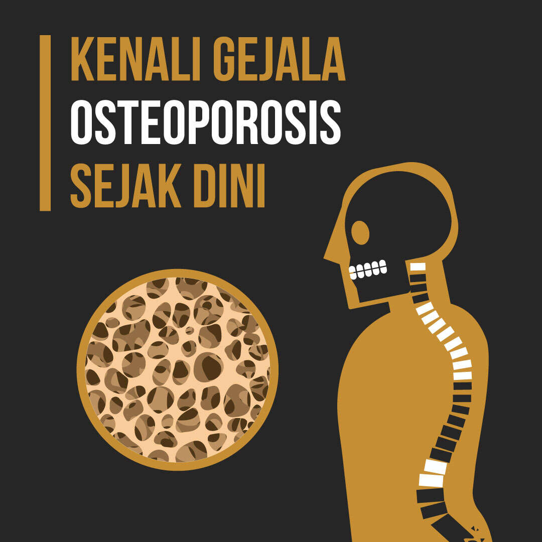 Kenali Gejala Osteoporosis Sejak Dini